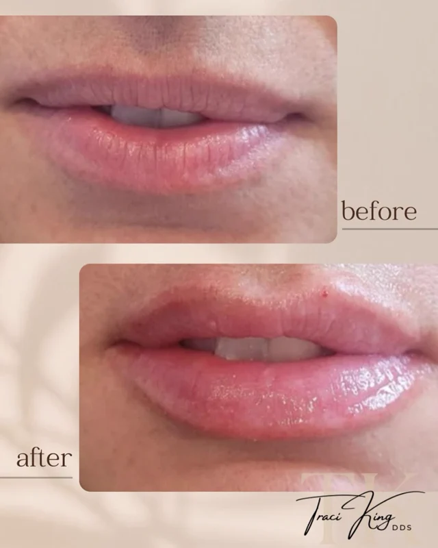 Lip comparison photographs shared by Payne & King