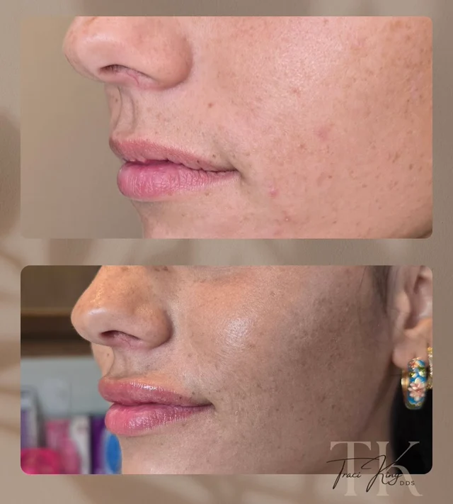 Lip profile comparison photographs shared by Payne & King