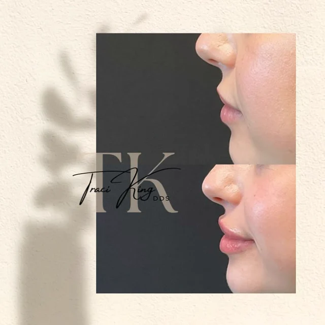 Lip profile comparison photographs shared by Payne & King