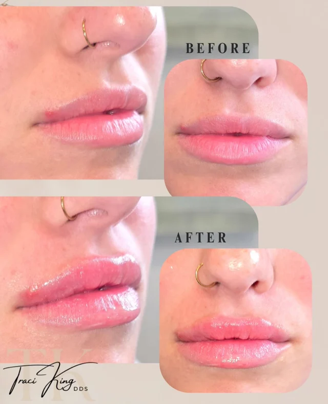 Lip comparison · two views photographs shared by Payne & King
