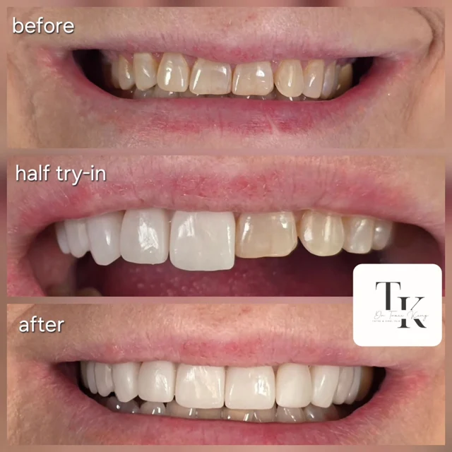 Three photographs labeled before, half try-in and after, shared by Payne & King